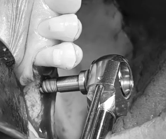 Implante dental